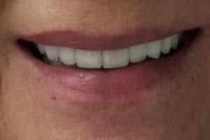 before and after dental care at Henrich Dental