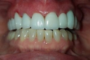 before and after dental care at Henrich Dental