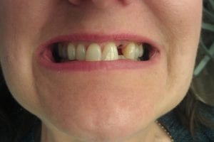 before and after dental care at Henrich Dental