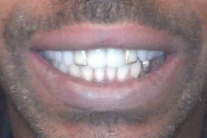 before and after dental care at Henrich Dental