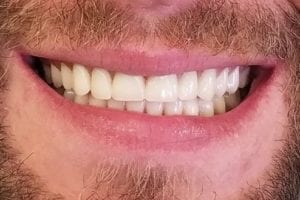 before and after dental care at Henrich Dental