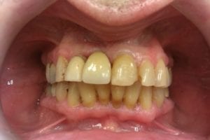 before and after dental care at Henrich Dental