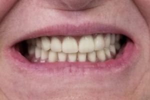 before and after dental care at Henrich Dental