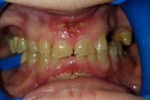before and after dental care at Henrich Dental