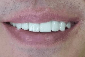 before and after dental care at Henrich Dental