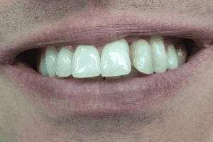 before and after dental care at Henrich Dental