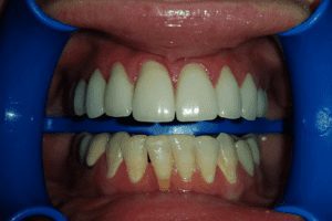 before and after dental care at Henrich Dental