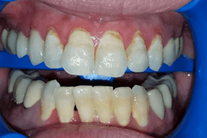 before and after dental care at Henrich Dental