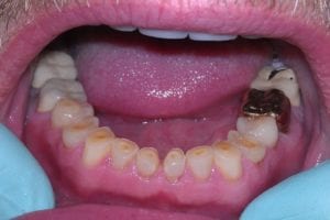 before and after dental care at Henrich Dental