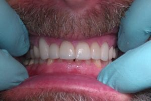 before and after dental care at Henrich Dental