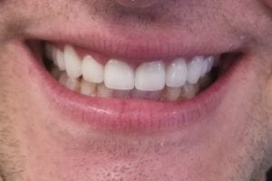 before and after dental care at Henrich Dental