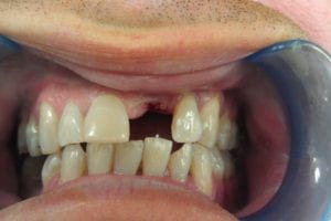 before and after dental care at Henrich Dental