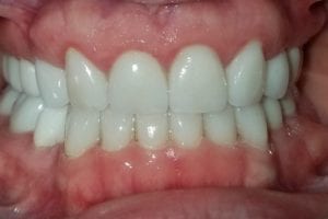 before and after dental care at Henrich Dental