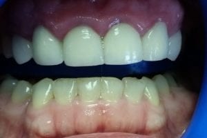 before and after dental care at Henrich Dental