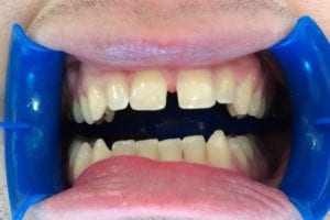 before and after dental care at Henrich Dental