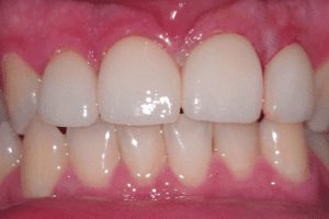 before and after dental care at Henrich Dental