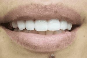 before and after dental care at Henrich Dental