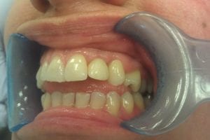 before and after dental care at Henrich Dental