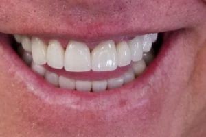 before and after dental care at Henrich Dental