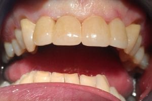 before and after dental care at Henrich Dental