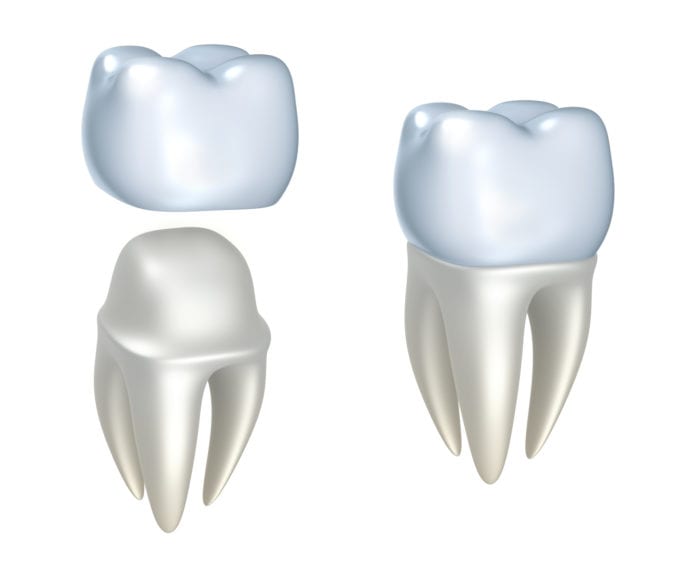 dental crowns in Tulsa Oklahoma