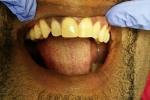 before and after dental care at Henrich Dental