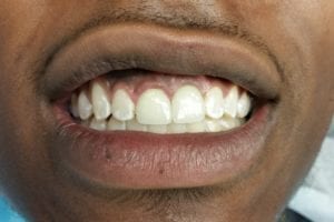 before and after dental care at Henrich Dental