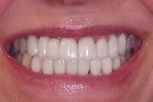 before and after dental care at Henrich Dental