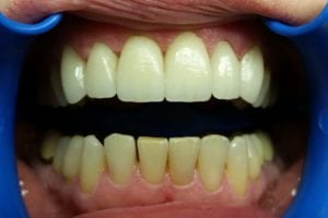 before and after dental care at Henrich Dental