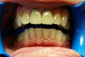 before and after dental care at Henrich Dental