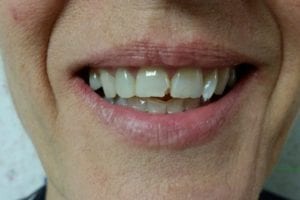 before and after dental care at Henrich Dental