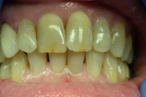 before and after dental care at Henrich Dental