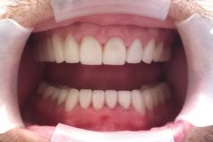 before and after dental care at Henrich Dental