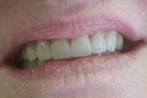 before and after dental care at Henrich Dental