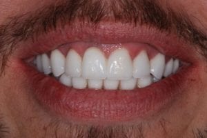 before and after dental care at Henrich Dental