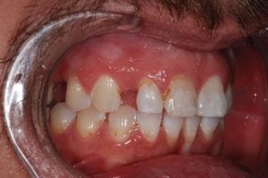 before and after dental care at Henrich Dental
