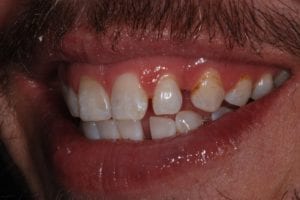 before and after dental care at Henrich Dental