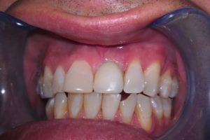 before and after dental care at Henrich Dental