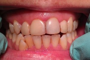 before and after dental care at Henrich Dental