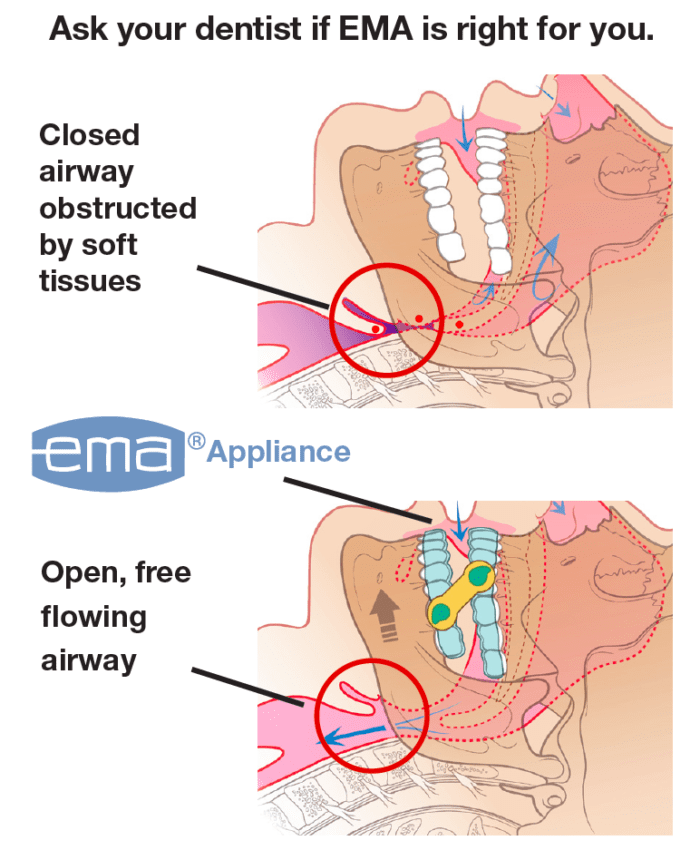Ask your dentist if EMA is right for you