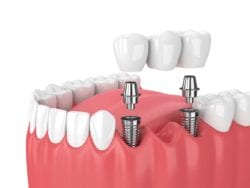tulsa, oklahoma dental implants