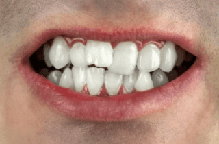 close up of mouth with bite problem dentist in Tulsa Oklahoma