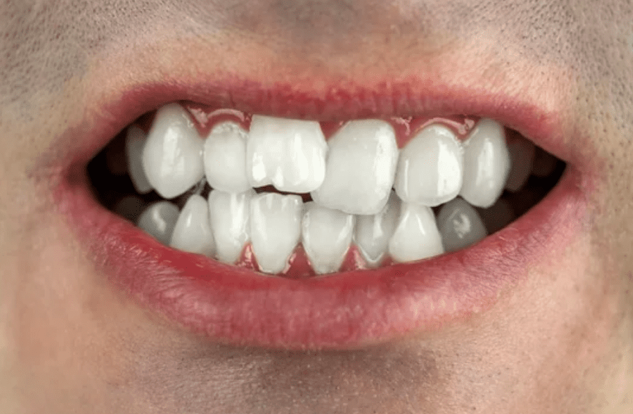 What Is a Bite Problem? Dentist in Tulsa, OK