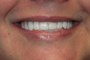 before and after dental care at Henrich Dental