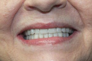 before and after dental care at Henrich Dental