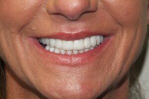 before and after dental care at Henrich Dental