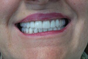 before and after dental care at Henrich Dental