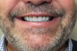 before and after dental care at Henrich Dental