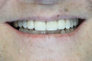 before and after dental care at Henrich Dental