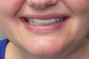 before and after dental care at Henrich Dental